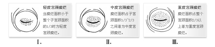 症状 白带增多 白带增多为宫颈糜烂的主要症状,通常白带呈乳白色或淡